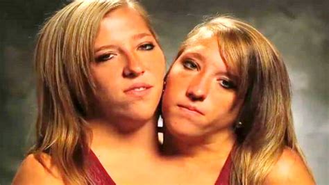 Что стало с сестрами Хенсел Судьба сиамских близнецов Youtube