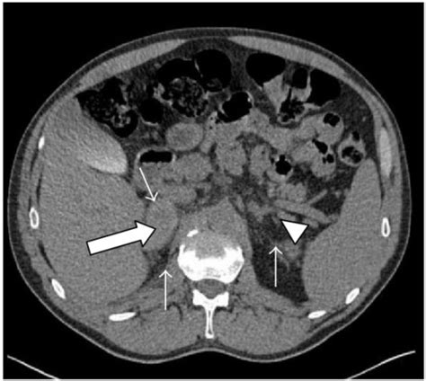 Adrenal Ct Without Contrast Reveals Right Adrenal Mass Open I