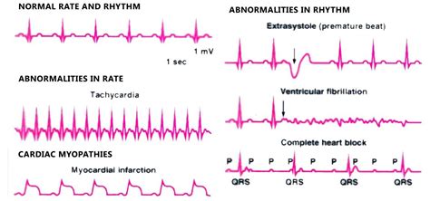 A Quick Guide To Ecg