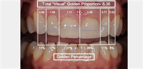 Using Golden Percentage In Dentistry For Ideal Tooth Proportions