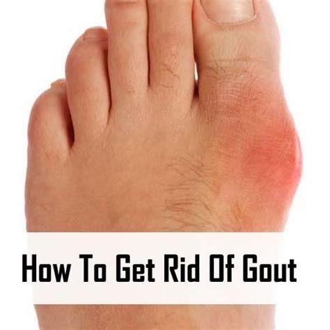 How To Get Rid Of Gout Ehomeremedi