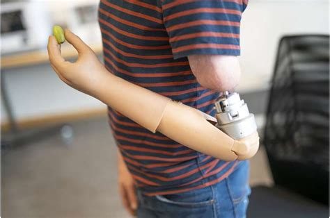 High Tech Prosthetic Arm Melds With Patients Anatomy