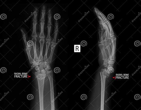 X Ray Of The Wrist Joint Fracture Of The Radius Marker Stock Image