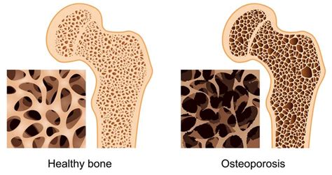 Multiple Sclerosis Foundation Prevent Osteoporosis With 6 Bone Health