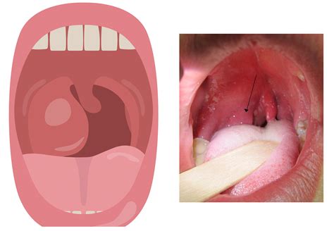 The Tonsils Waldeyers Ring Lingual Pharyngeal Palatine Tubal