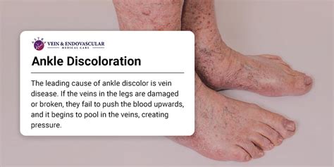 Ankle Discoloration Causes And Treatment Options Vein And Endovascular