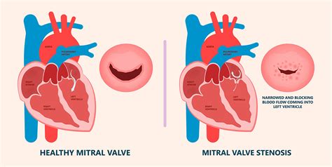 Mitral Valve Diseases Types Symptoms And Treatment Dr Raghu