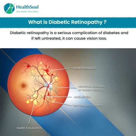 Diabetic Retinopathy Symptoms Diagnosis And Treatment Healthsoul