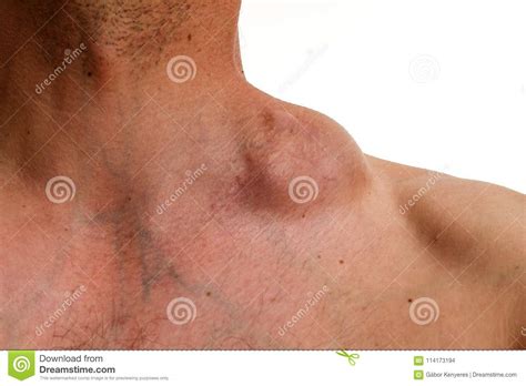 Scoprire un tumore sulla propria pelle è una doccia di ghiaccio, a 22 anni è un imprevisto a cui non penseresti. Tumore Di Hodgkin - Tumore Ingombrante - Linfoma Di ...