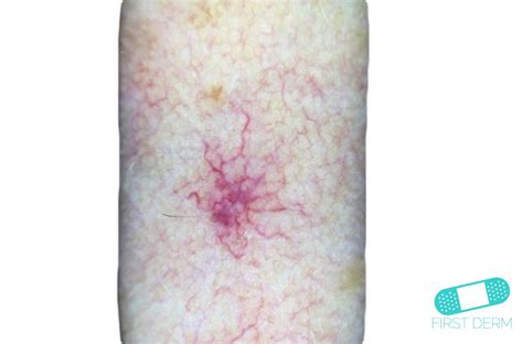 Red Age Spots Shefalitayal