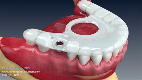 Dental Implant Animation Dental Clinic