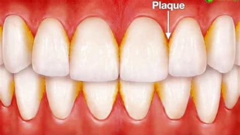 Plaque And Calculus Rawson Dental