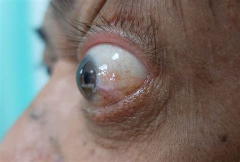 Eye Socket And Varia Diseases Ophthalmology Bellevue Clinic