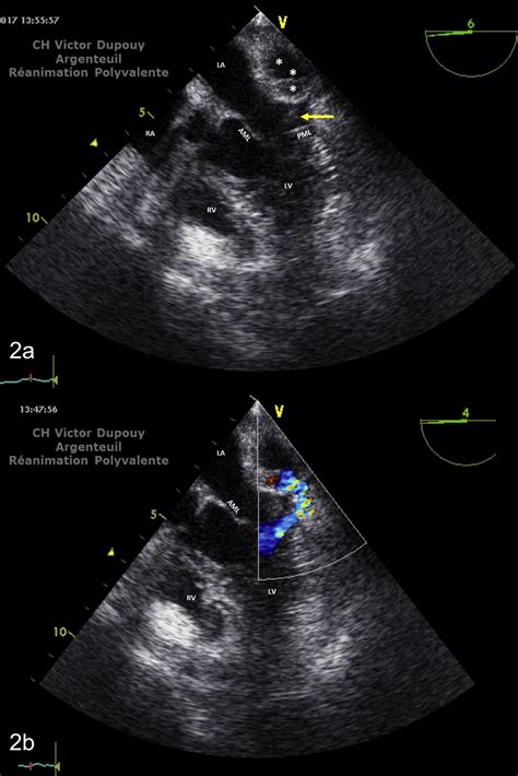 Perivalvular Mitral Abscess Fistulised To The Pericardial Cavity