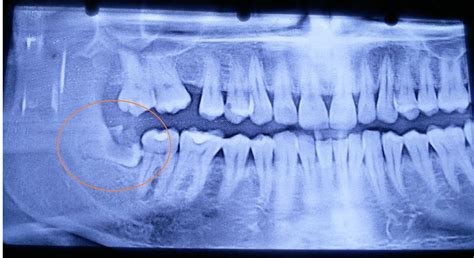 Surgical Extraction Of Impacted Wisdom Tooth 48 Wisdom Teeth