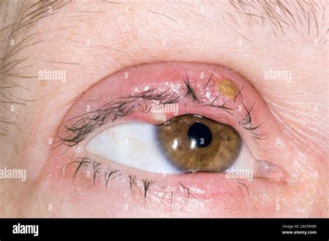 Eye Abscesses On The Upper Eyelid Of A 40 Year Old Woman These Are
