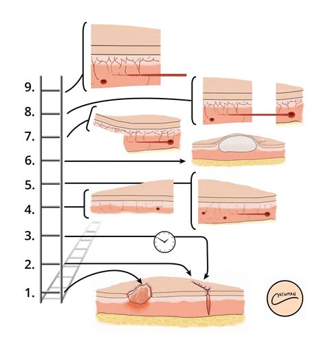 Principles Of Wound Management TeachMeSurgery