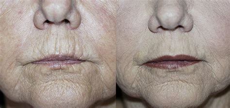 Lip Enhancement Wrinkles Sadove Cosmetic Surgery
