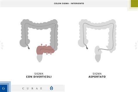 I Diverticoli I Sintomi Della Diverticolite E Il Percorso Di Cure