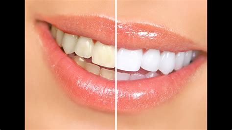 10 Simple Life Hacks For Teeth Whitening Everyone Should ...