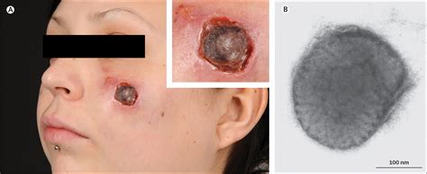 True form increases health, attack power and recharge time. Human cowpox in a veterinary student - The Lancet ...