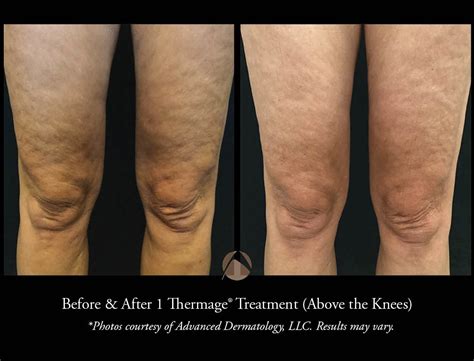 Thermage Procedure In Chicago Il Advanced Dermatology