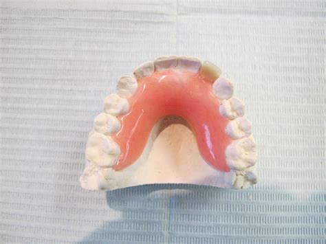 Acrylic Partial Baker Lanoue Denture Clinic