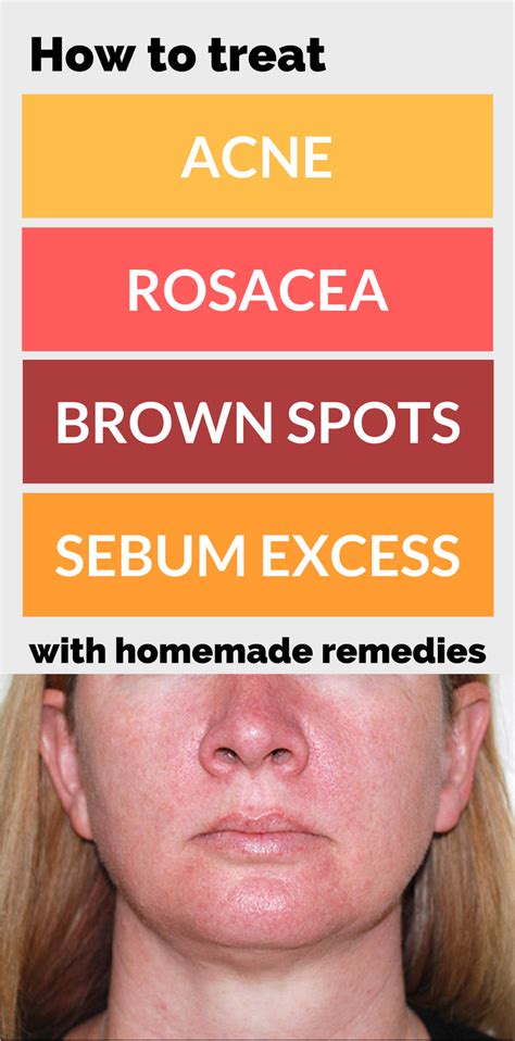How To Treat Acne Rosacea Brown Spots And Sebum Excess With Homemade