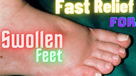 Swollen Feet Causes And Remedies Youtube