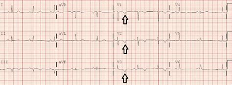 Resting 12 Lead Ekg Showing Symmetric T Wave Inversion In Right