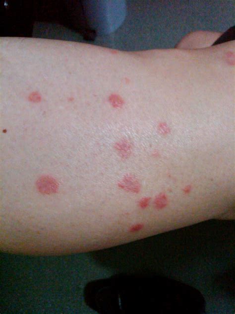 Red Spots On Legs Itchy Pictures Dots Patches Blotche