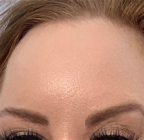 Skin Concern My Forehead Looks Like An Orange Peel Is There Anything