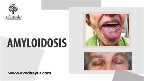 Amyloidosis Symptoms Causes Diagnosis And Ayurvedic Treatment