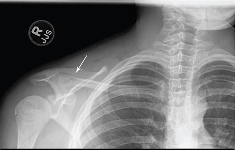 In Pieces Clavicle Fracture Radiology Key