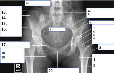 Image Review 4 Femur And Pelvic Girdle Flashcards Quizlet