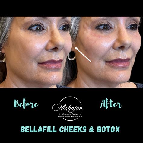 This Patient Received A Combination Of Bellafill In Her Cheeks And