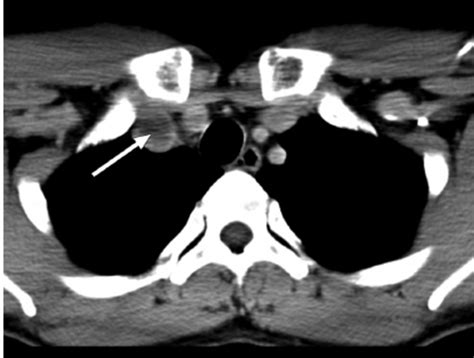 Contrast Enhanced Axial Ct Image Of The Neck Shows The Thrombus In The