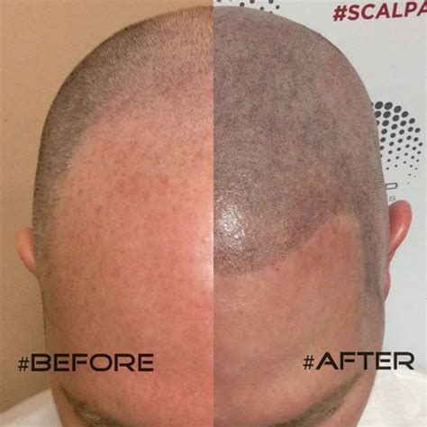Hair shedding is a natural and necessary part of the hair growth. Scalp Micropigmentation Hair Tattoos in Phoenix