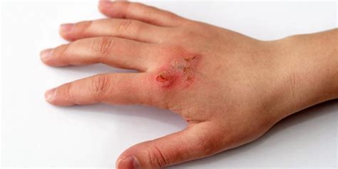 How To Treat Minor Burns At Home And When To Seek Medical Treatment