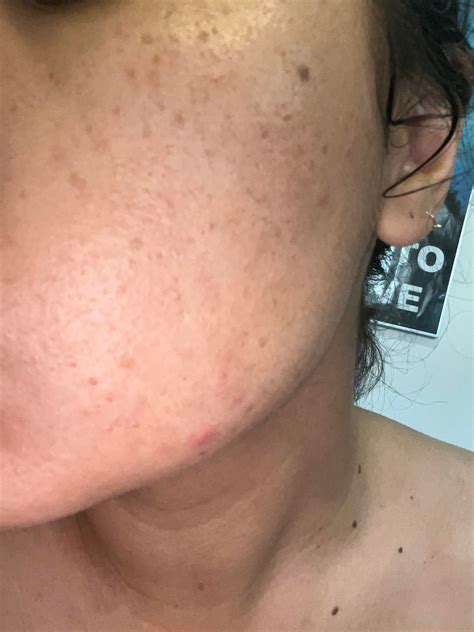 Anti Aging What Are These Brown Spots More In Comments R