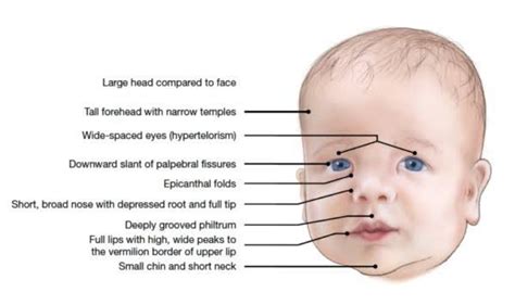 Symptoms And Facial Features Of Noonan Syndrome Medizzy