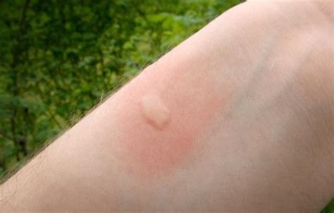 Mosquito Bites On Humans
