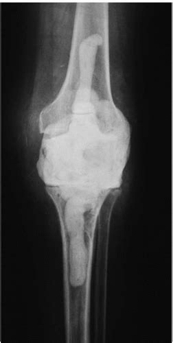 Arthrodesis For The Chronically Infected Total Knee Arthroplasty