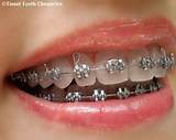 Pictures of Metallic Silver Braces