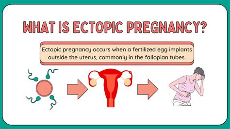 Ectopic Pregnancy Pain Pre Rupture Symptoms And Warning Signs