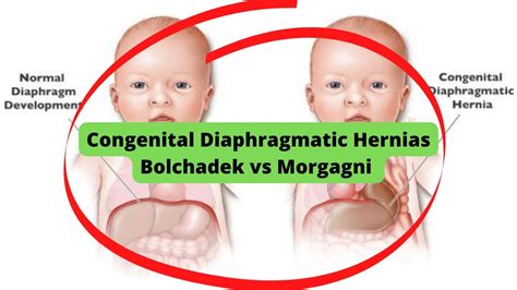 Bolchadek Vs Morgagni Congenital Diaphragmatic Hernias Youtube