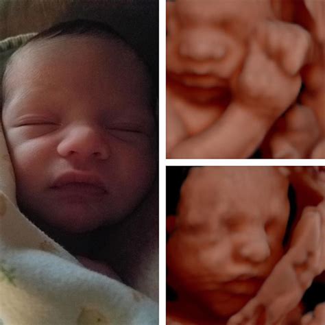 Maybe you would like to learn more about one of these? Before and After 3D ultrasound images