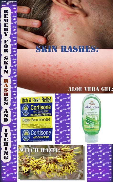 Natural Remedies To Easily Recover From Skin Rashes And Itching Skin Redness Natural Skin