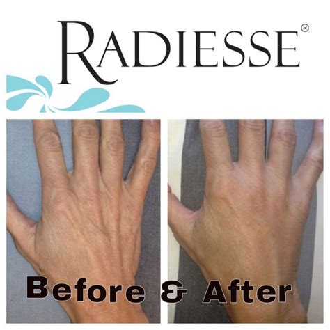 don t let your hands give your age away try radiesse wine making kits facial aesthetics