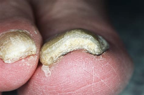 Higher Pharmacy Costs For Brand Name Vs Generic Onychomycosis